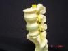 spine model showing slipped disc causing scaitica